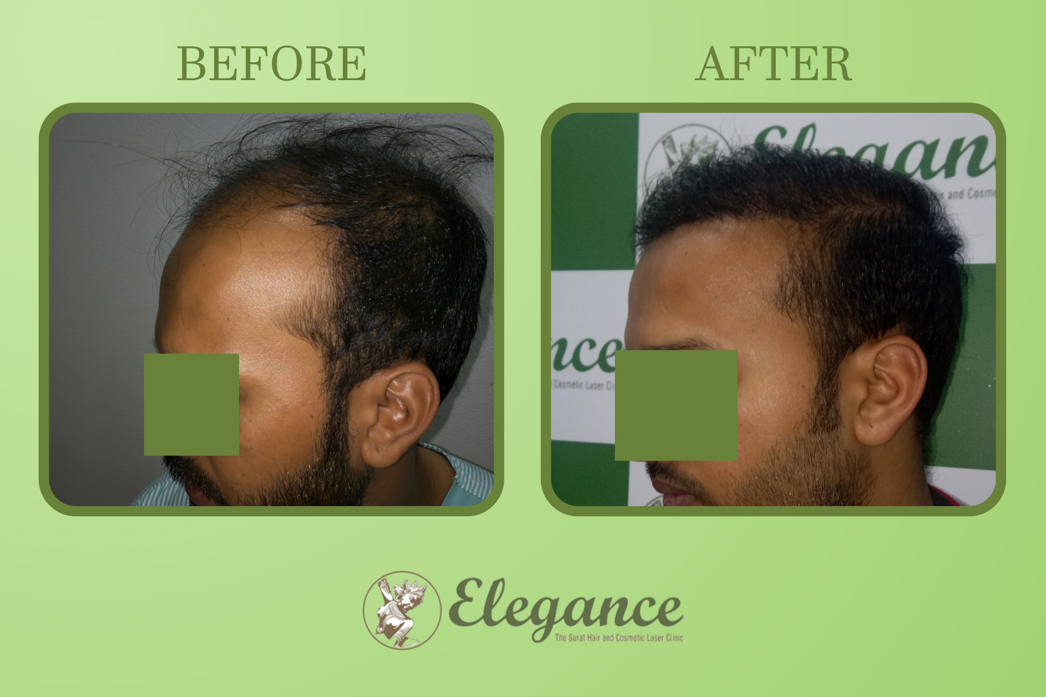 Hair transplant in Ahmedabad, Gujarat, India
