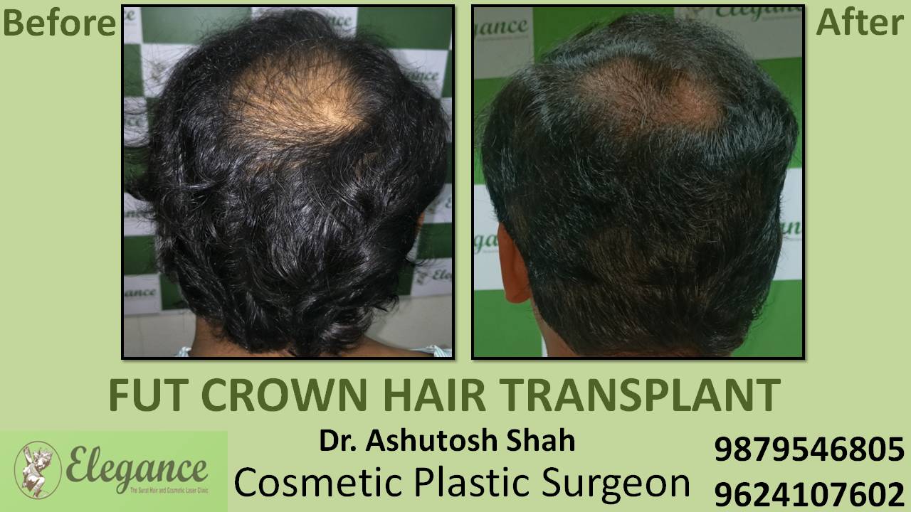 Hair Transplant in Pune Elegance Clinic Surat