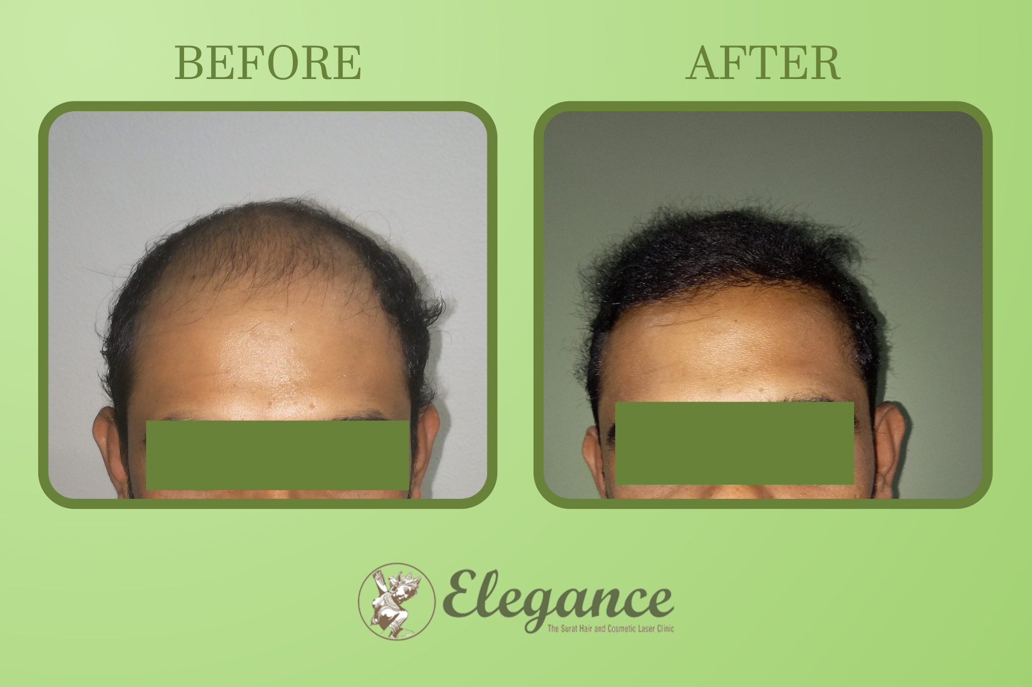 Hair Transplant Surgery Cost in Gujarat, India