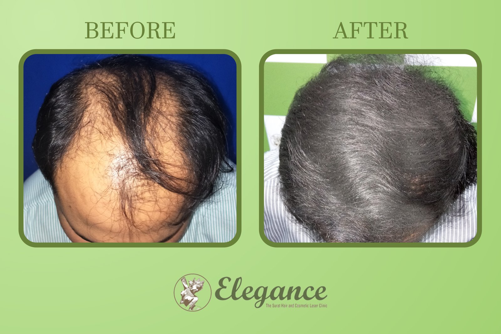 Hair Transplant Surgery in Ahmedabad, Gujarat, India