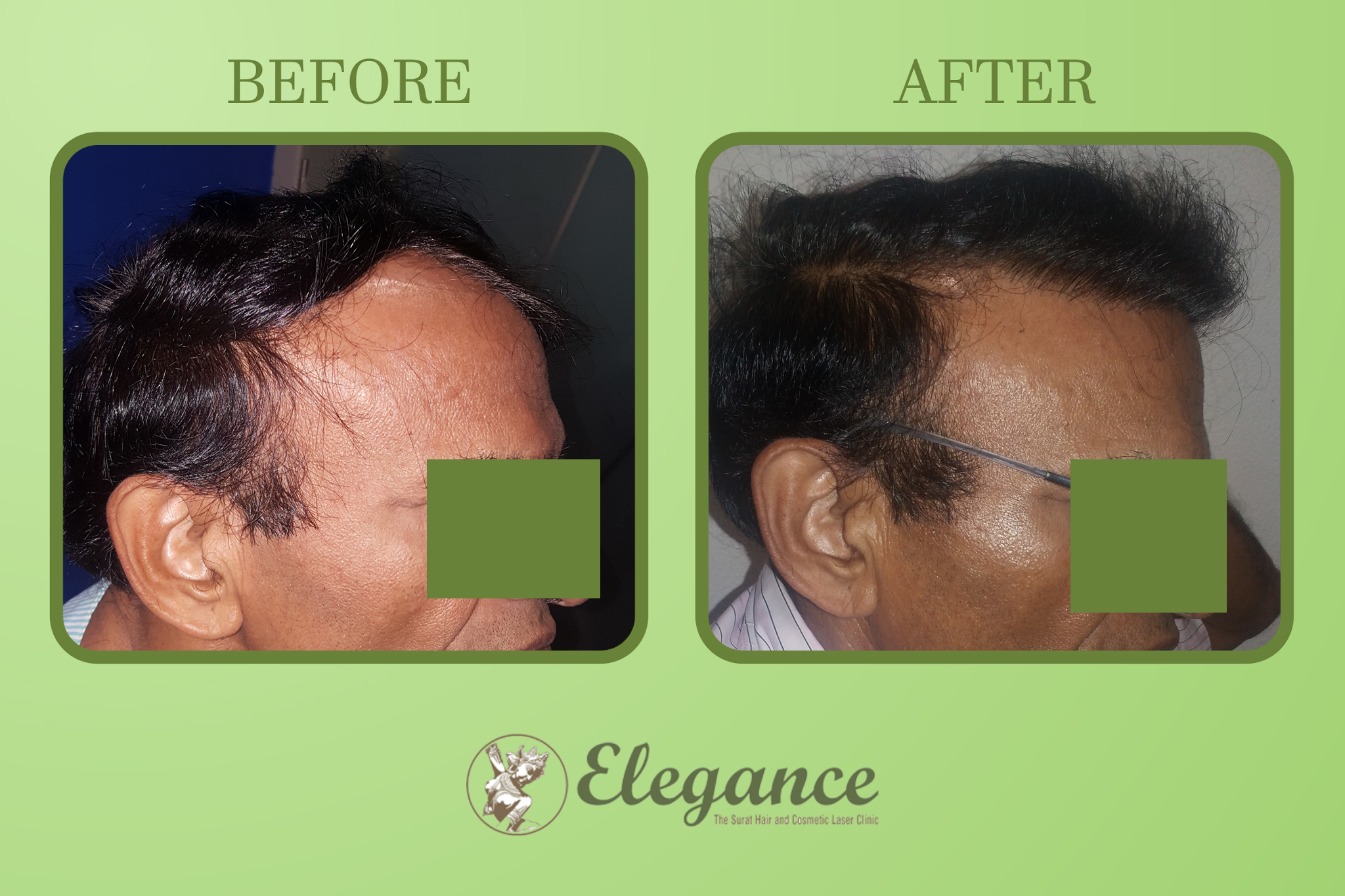Hair Transplant Surgery in Anand, Gujarat, India