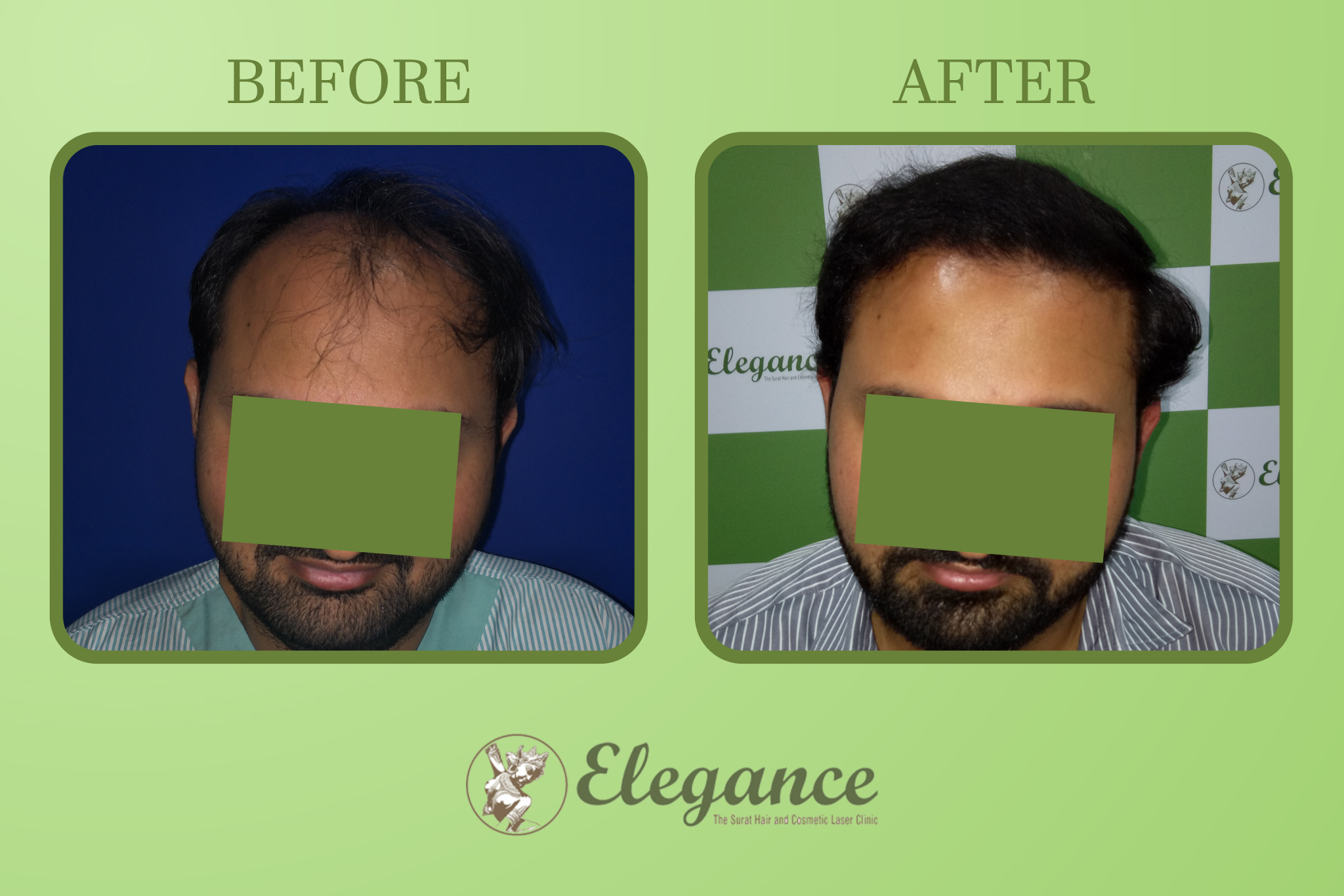 Hair Transplant Surgery in Gandhinagar, Gujarat, India
