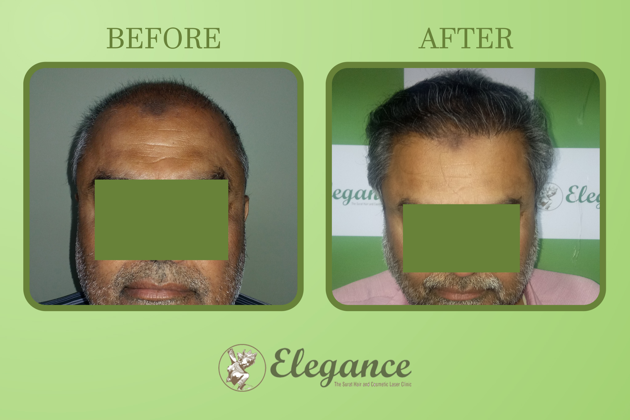Hair Transplant Surgery in Jamnagar, Gujarat, India