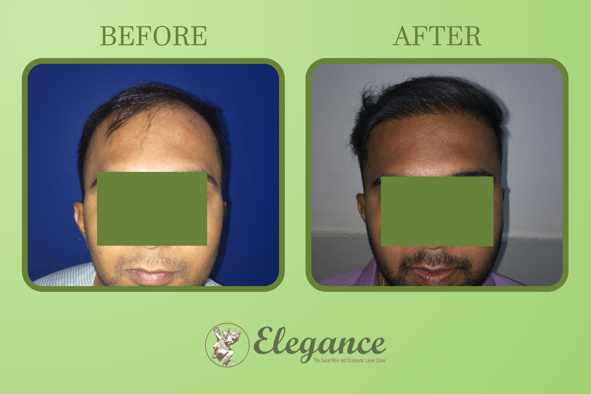 Hair Transplant Surgery in Katargam, Surat, Gujarat, India