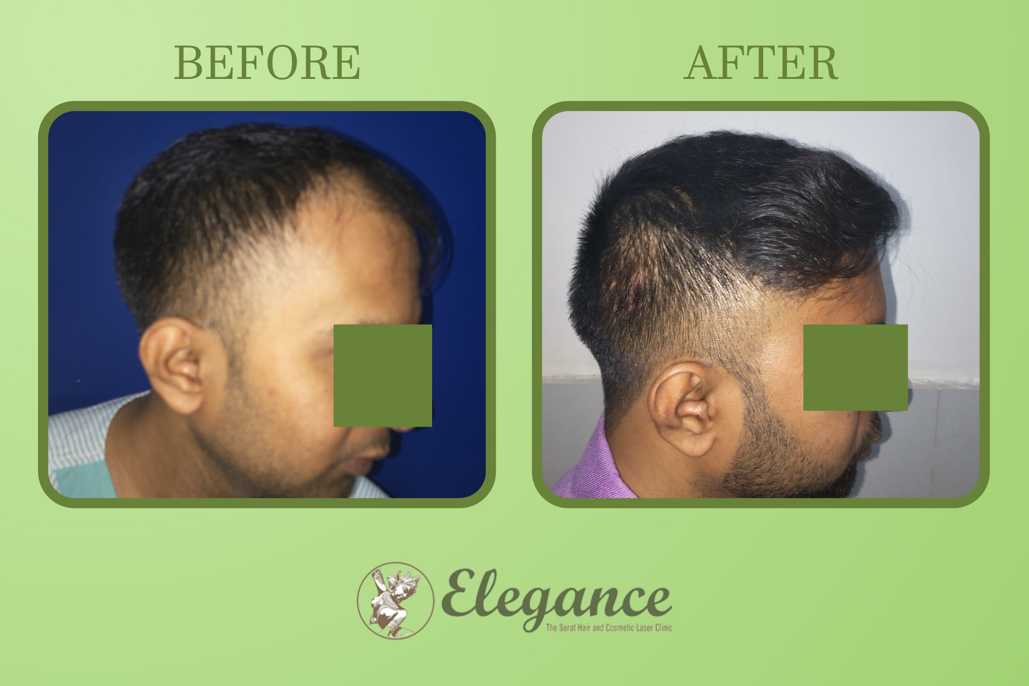 Hair Transplant Surgery in Pandesara, Surat, Gujarat, India