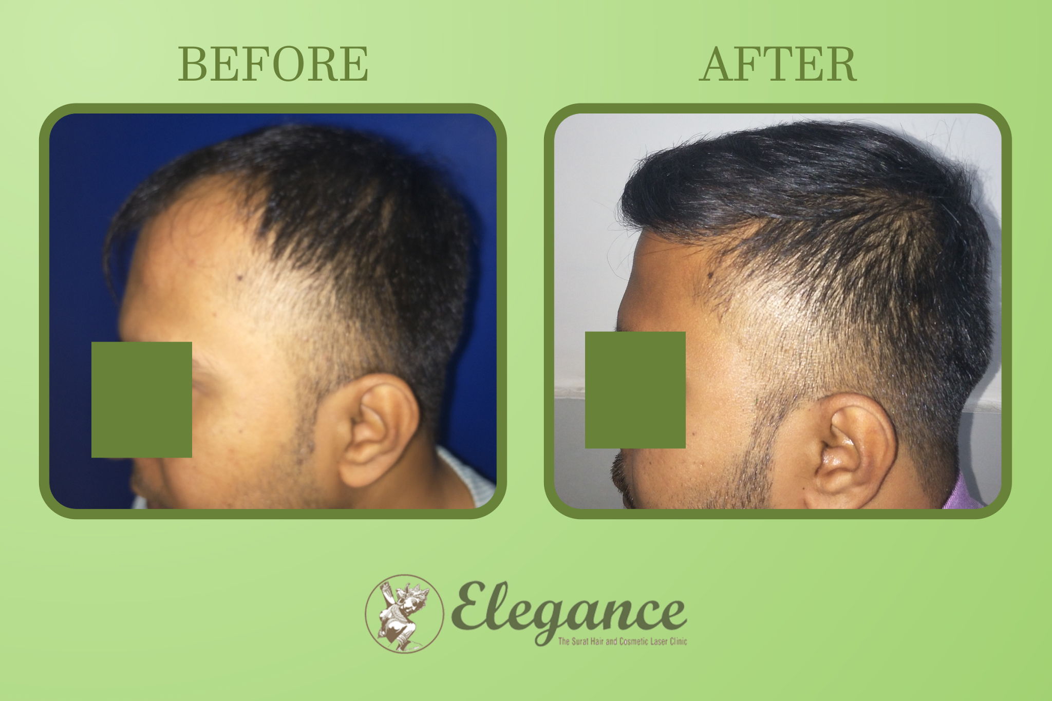 Hair Transplant Surgery in Surat, Gujarat, India