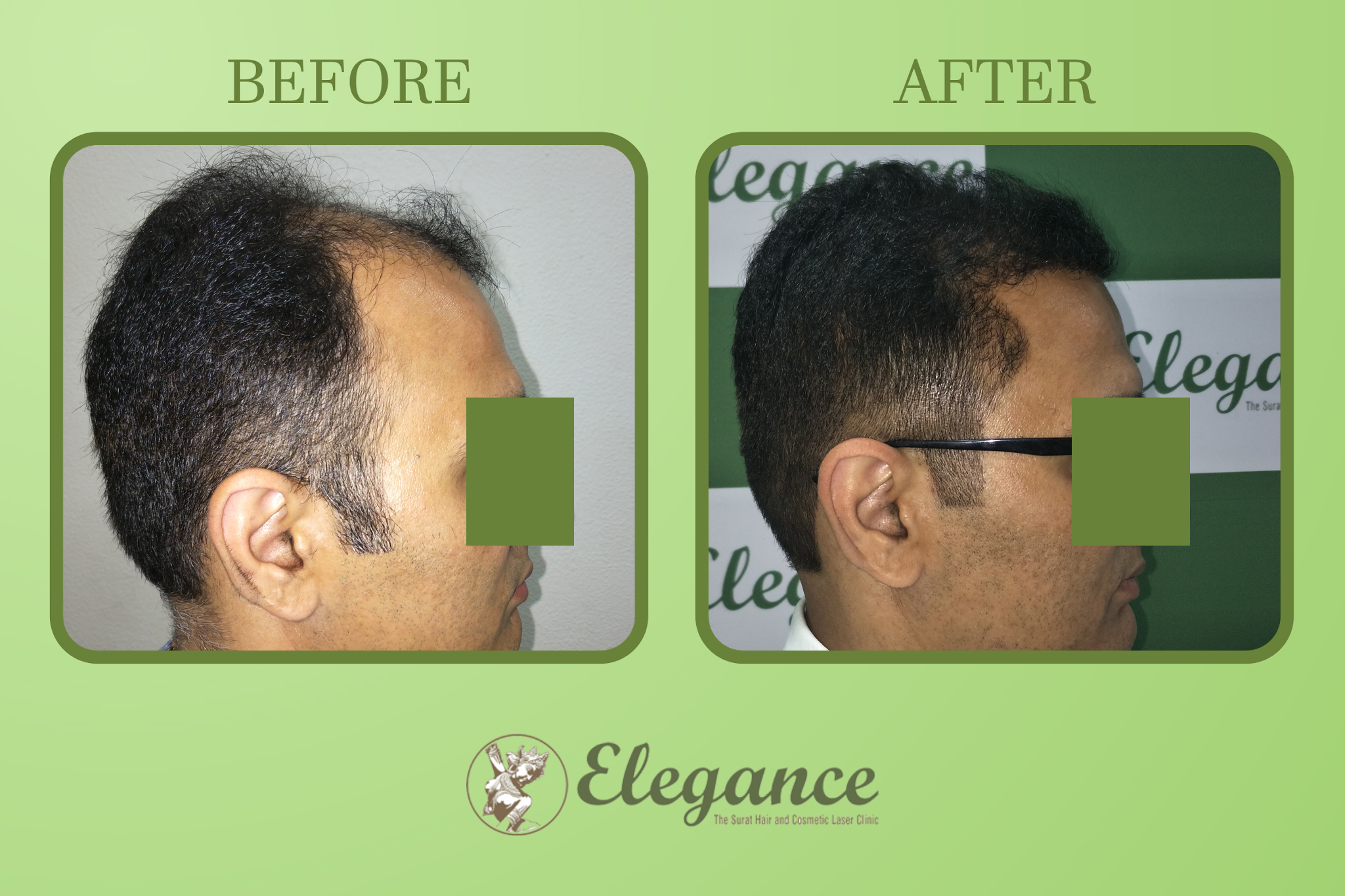 Hair Transplant Surgery in Vadodara, Gujarat, India