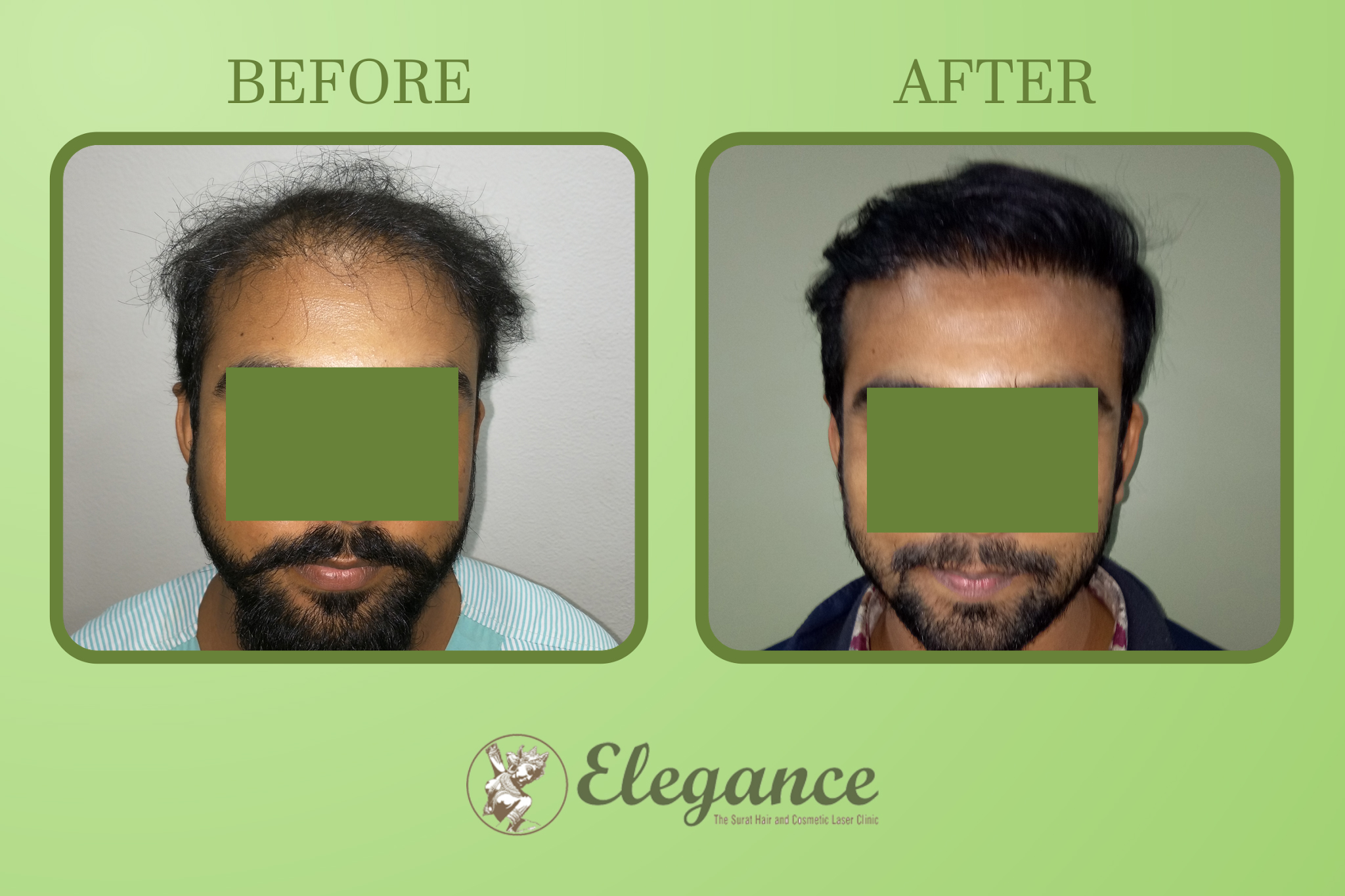 Hair Transplant Surgery in Valsad, Gujarat, India