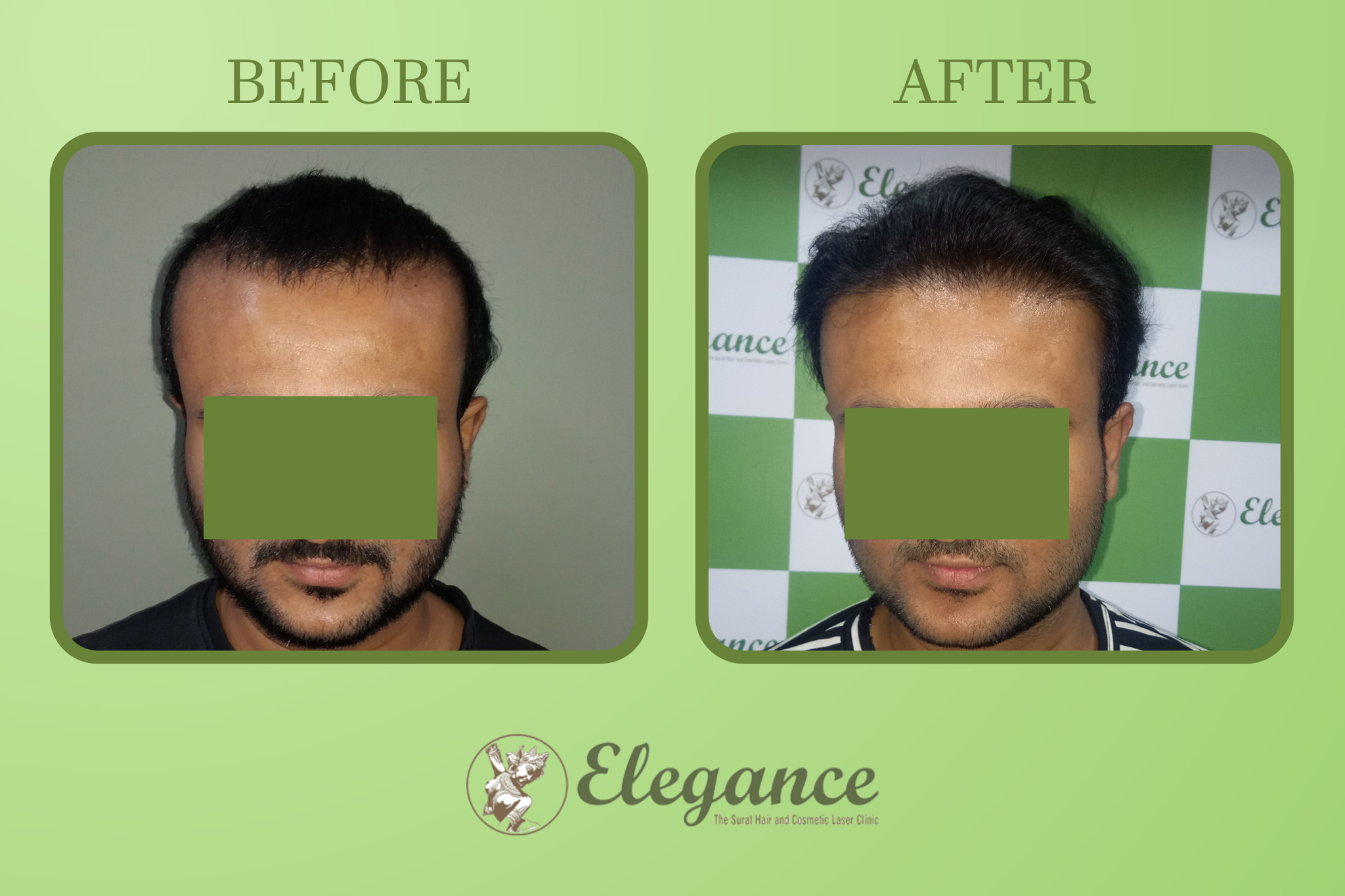 Hair Transplant Surgery in Vesu, Surat, Gujarat, India