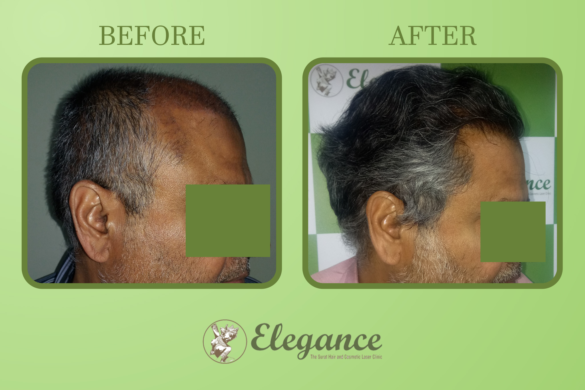Hair Transplant Surgey in Bhavnagar, Gujarat, India
