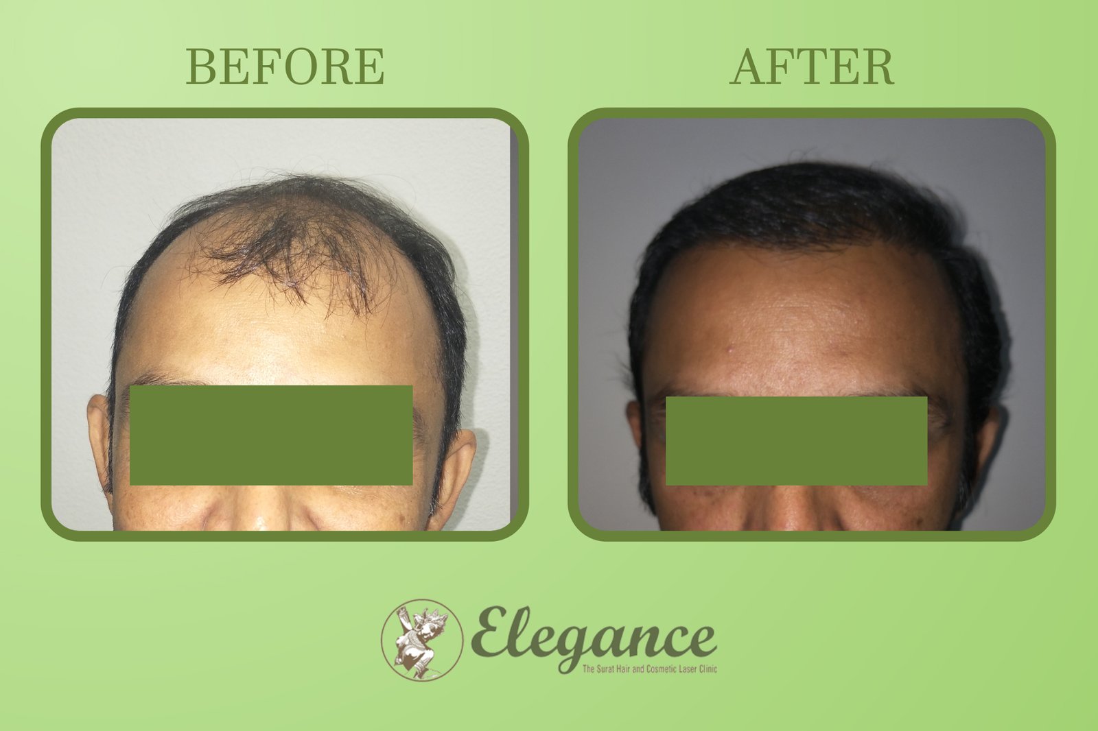 Hair Transplant Surgey in Junagadh, Gujarat, India