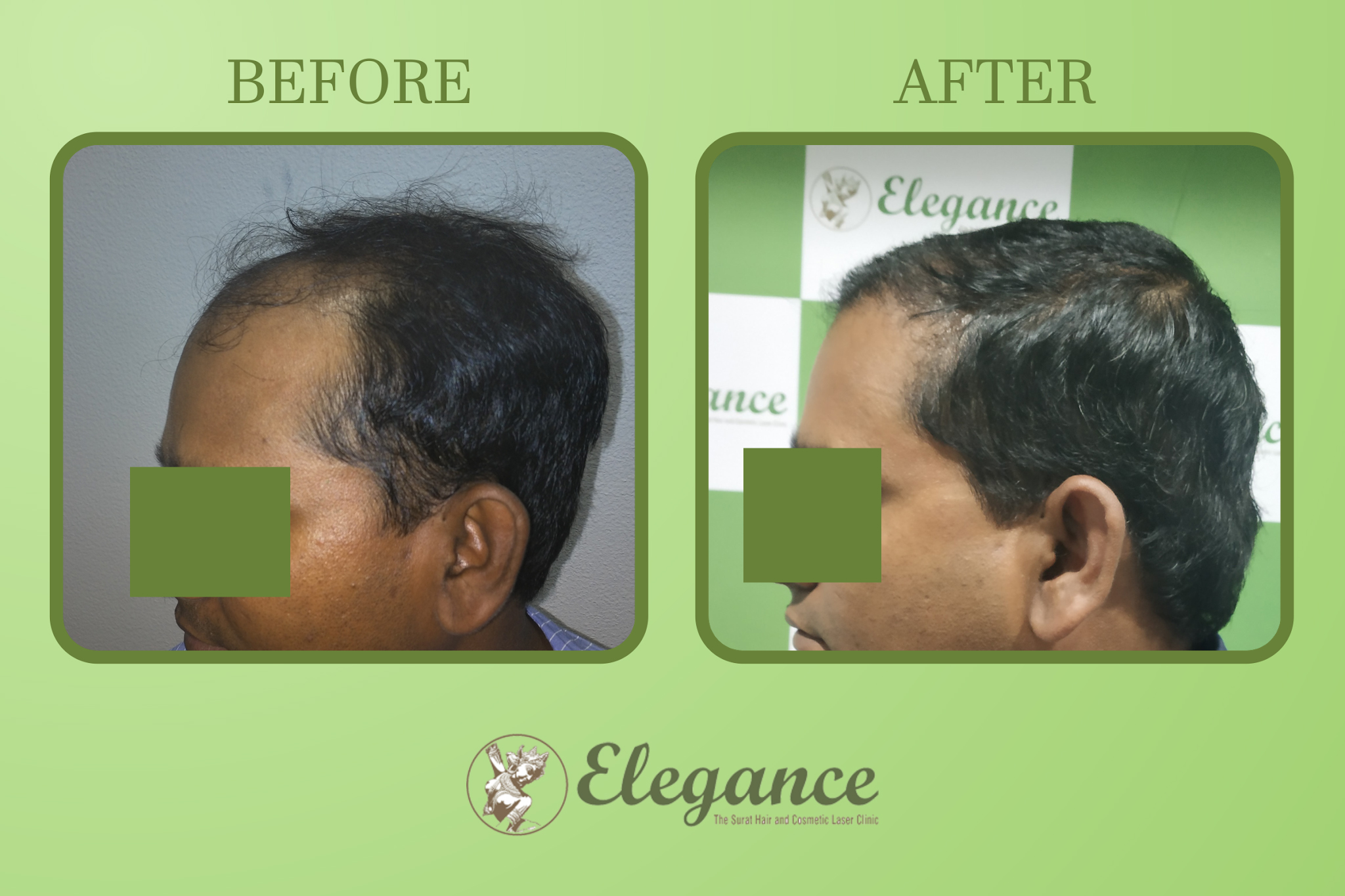 Hair Transplant Treatment In Althan, Surat, Gujarat, India