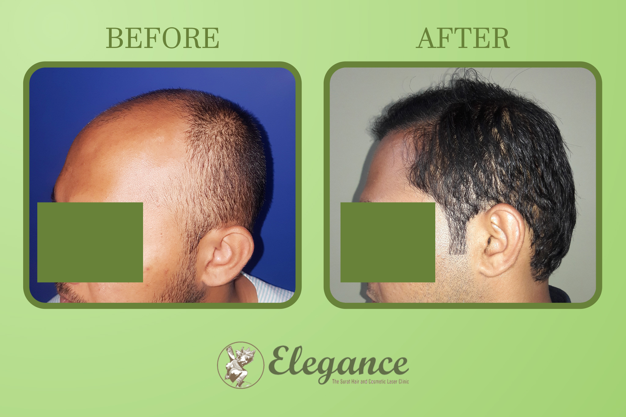 Best Hair Transplant for Men in Surat, Gujarat (India)