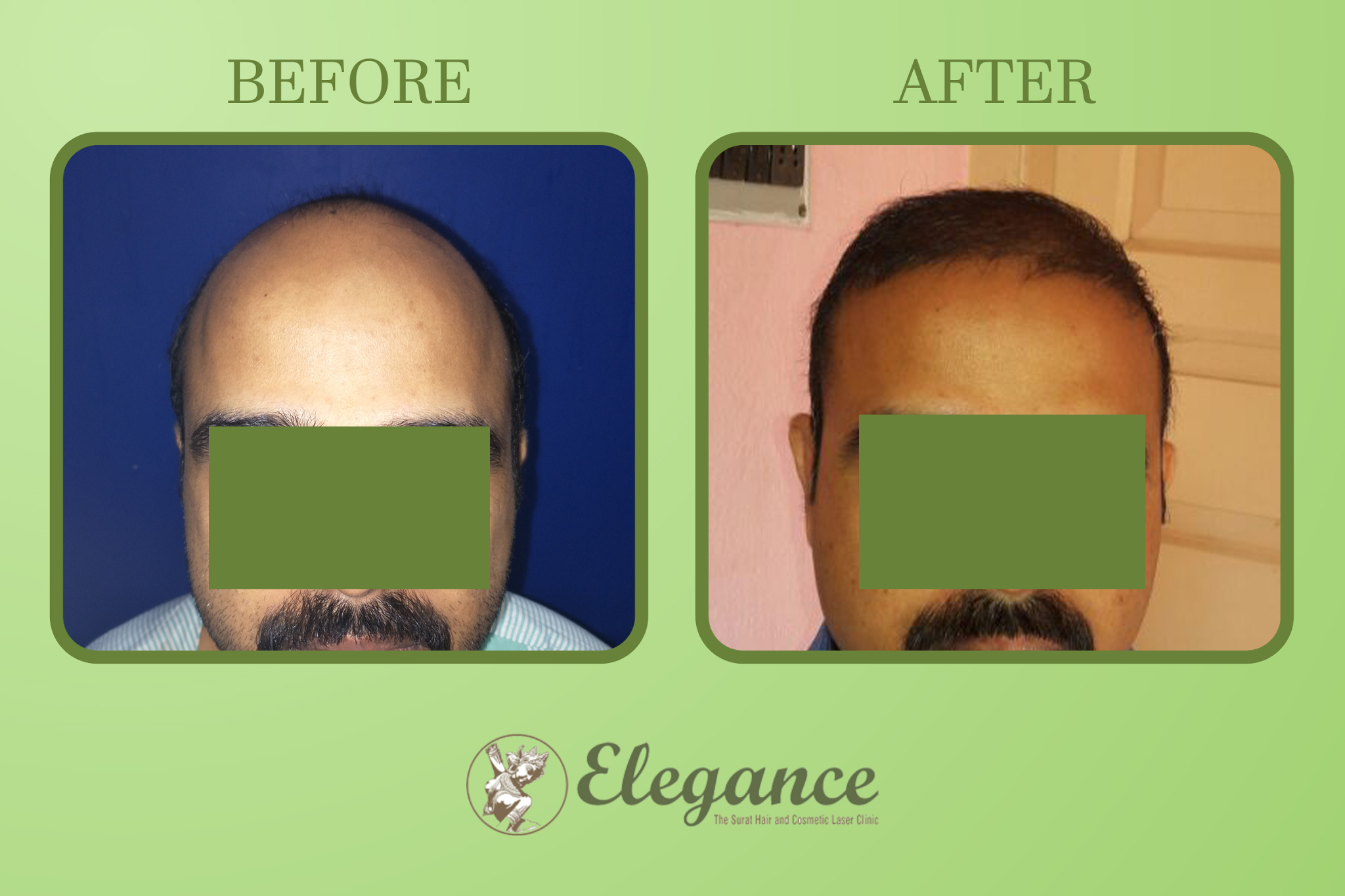 Hair Transplant Treatment In Parle Point, Surat, Gujarat, India