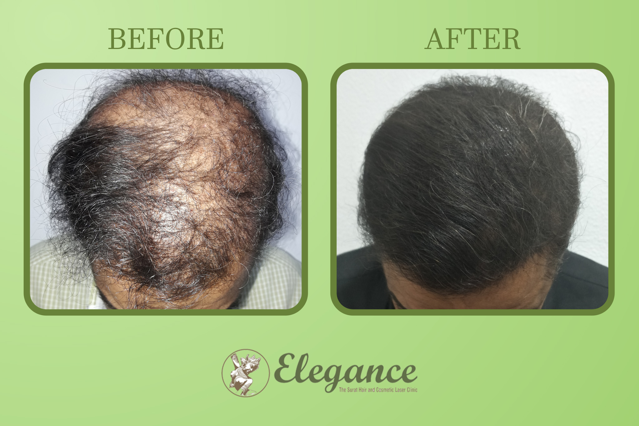 Hair Transplant Treatment In Utran, Surat, Gujarat, India