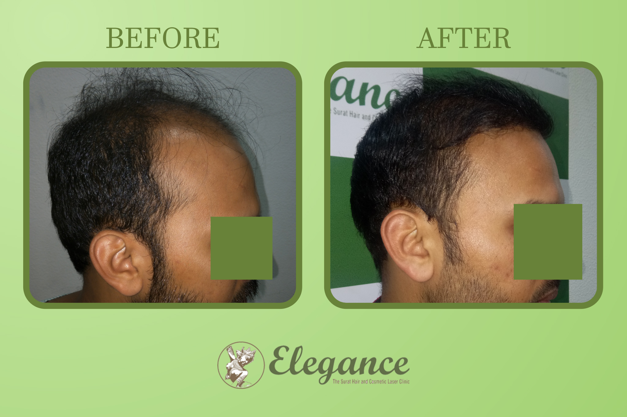 Hair Transplant Treatment in Porbandar, Gujarat, India