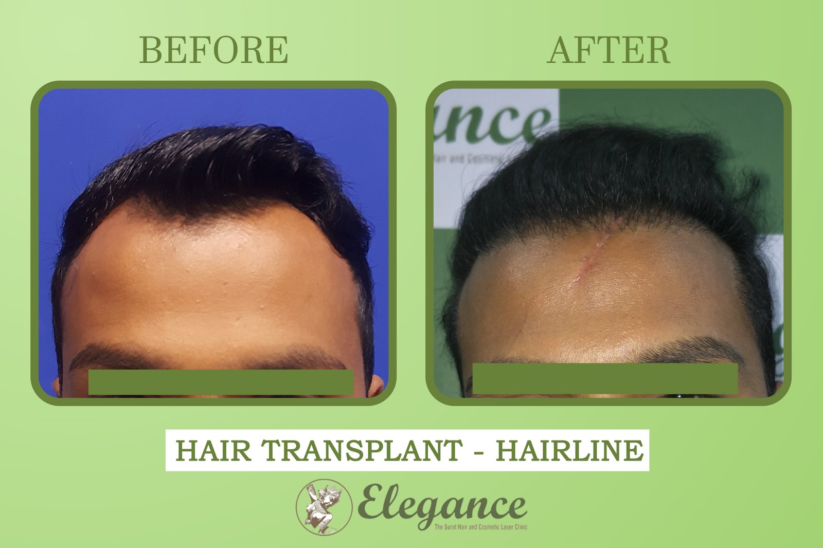 Best Fue Hair Transplant Ankleswar, Gujarat, India