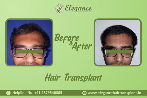 Best Hair Transplant in Vapi, Gujarat, india