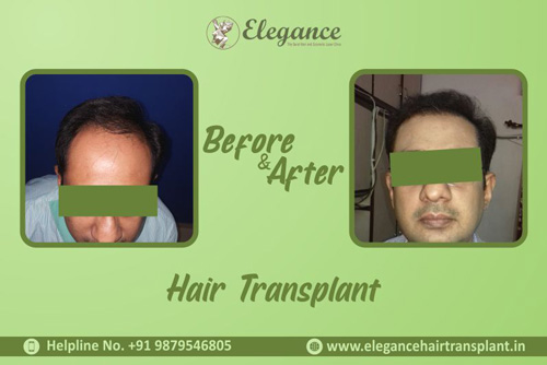 Hair Transplant in Vapi, Gujarat, india