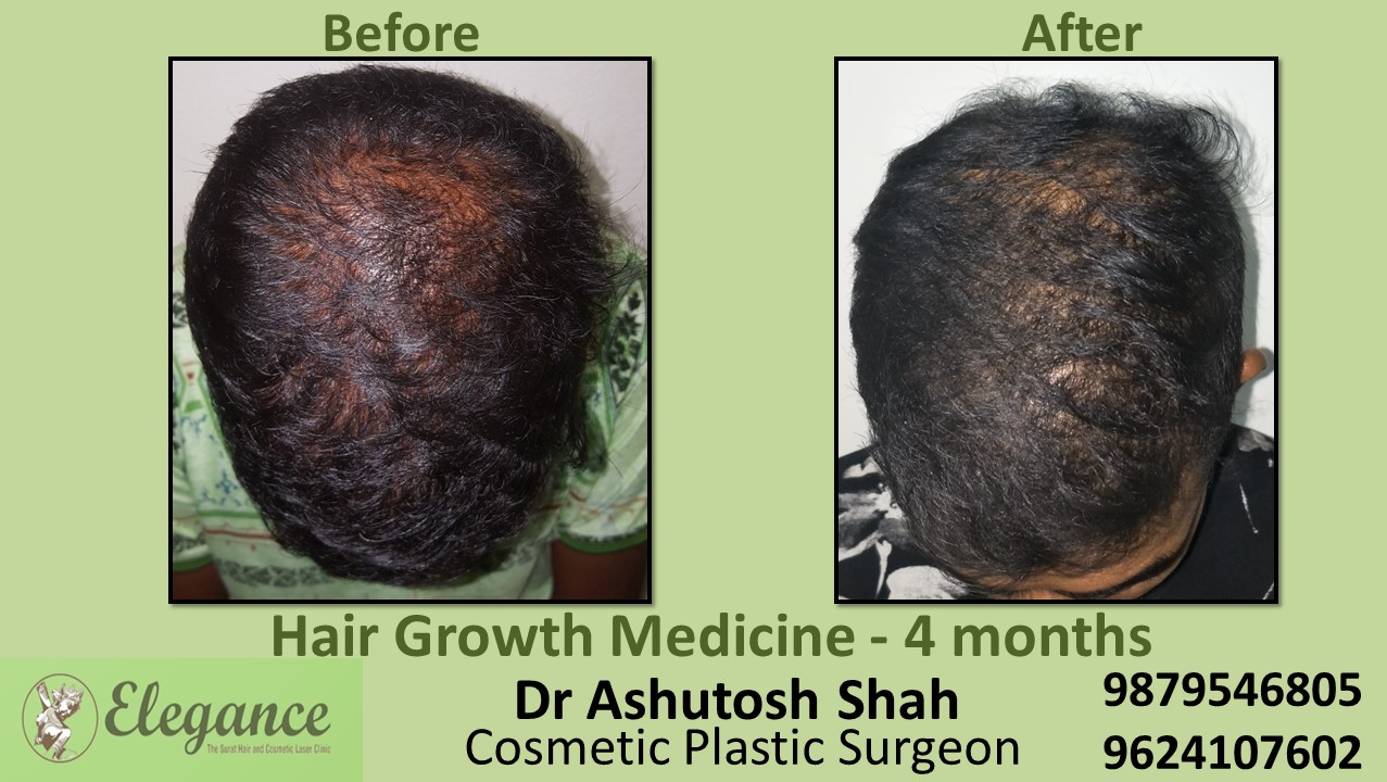 Doctors for Hair Growth with Medication in Bardoli, Gujarat