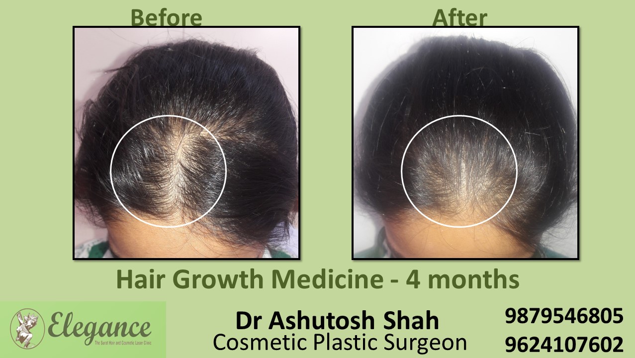 Doctors for Hair Growth with Medication in kosamba, Gujarat