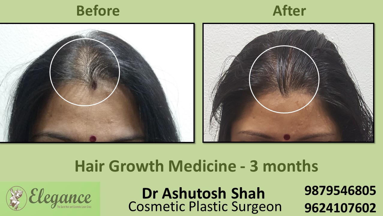 Doctors for Hair Growth with Medication in Surat, Gujarat