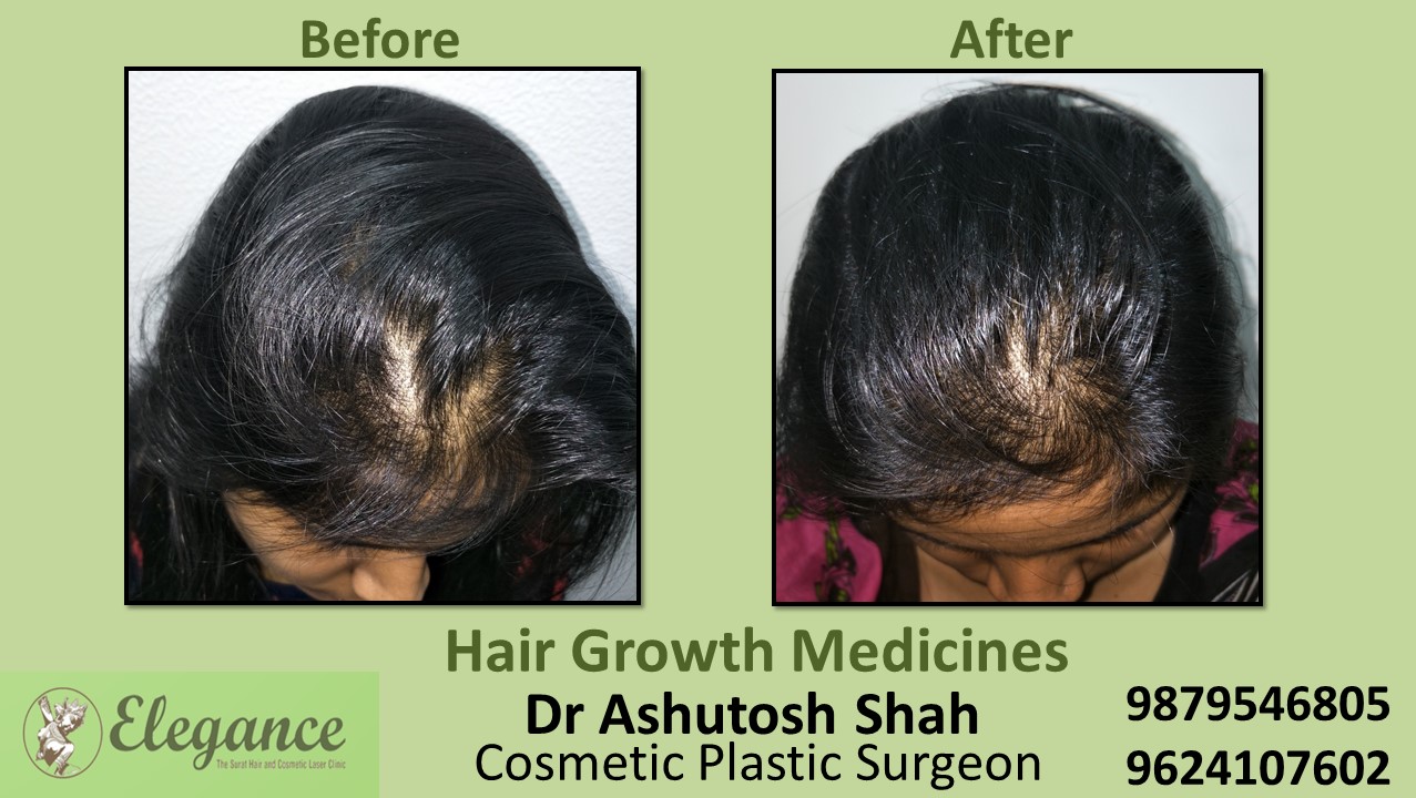 Experts for Hair Loss Medicine In Surat Gujarat