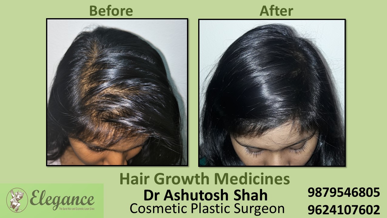 Experts for Hair Loss Medicine In Vapi Gujarat