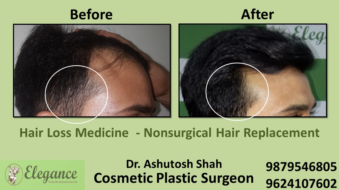 Hair Loss Medication in Bardoli, Surat