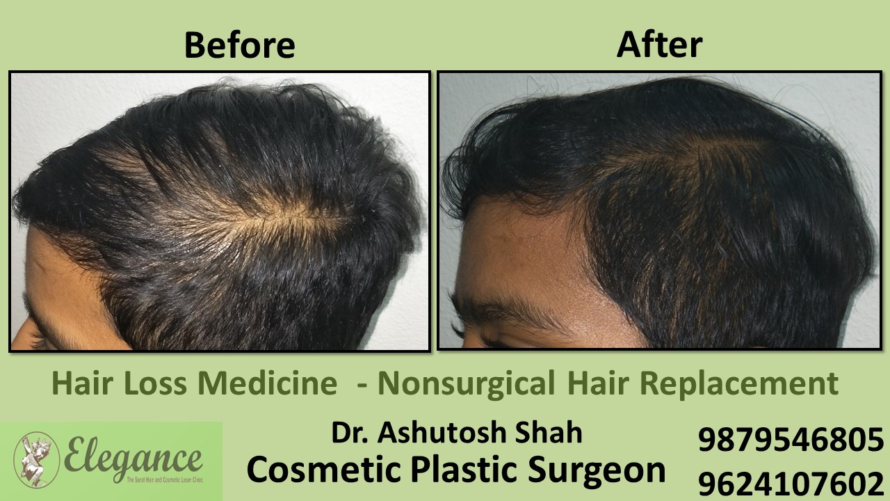Hair Loss Medication in Navsari, Surat