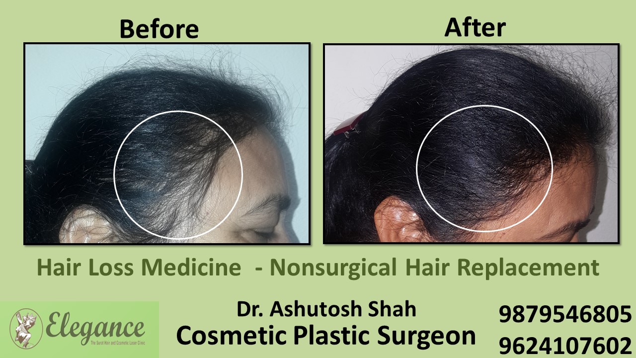 Hair Loss Medication in Piplod, Surat