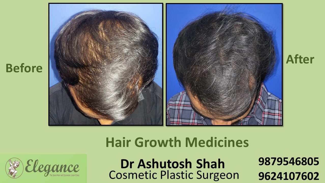 Hair Loss Treatment through Medication in Ahmadabad, Gujarat
