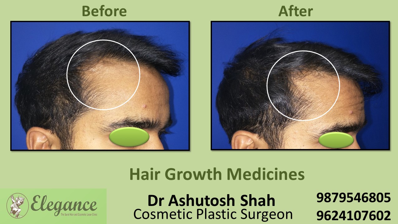 Hair Loss Treatment through Medication in Bharuch, Gujarat