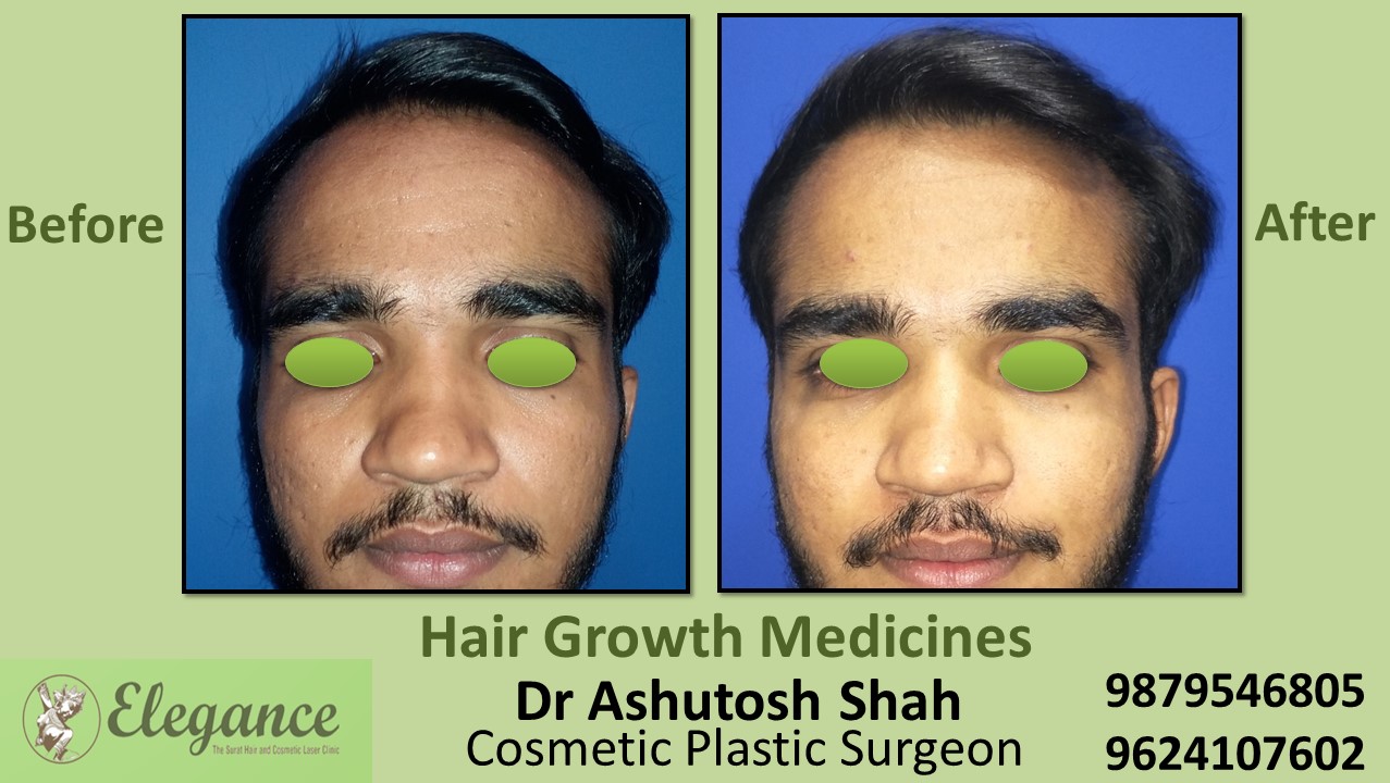 Hair Loss Treatment through Medication in Surat, Gujarat