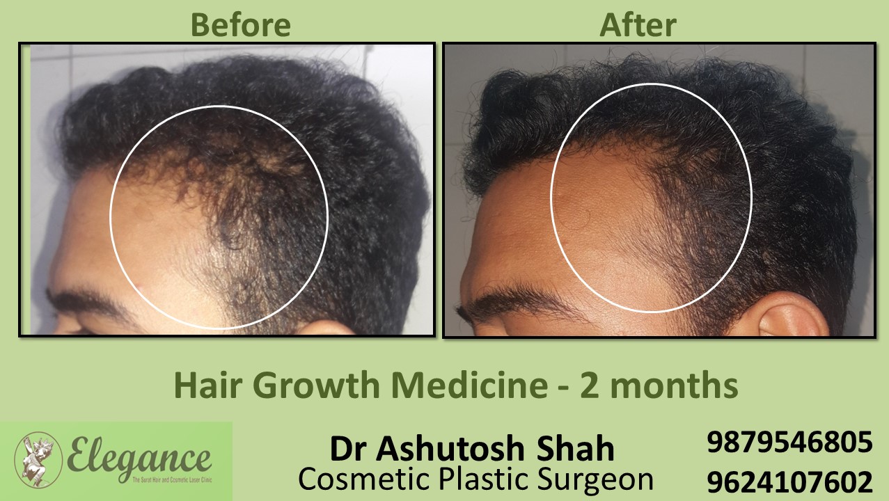 Hair Loss Treatment with Medicine in Mumbai