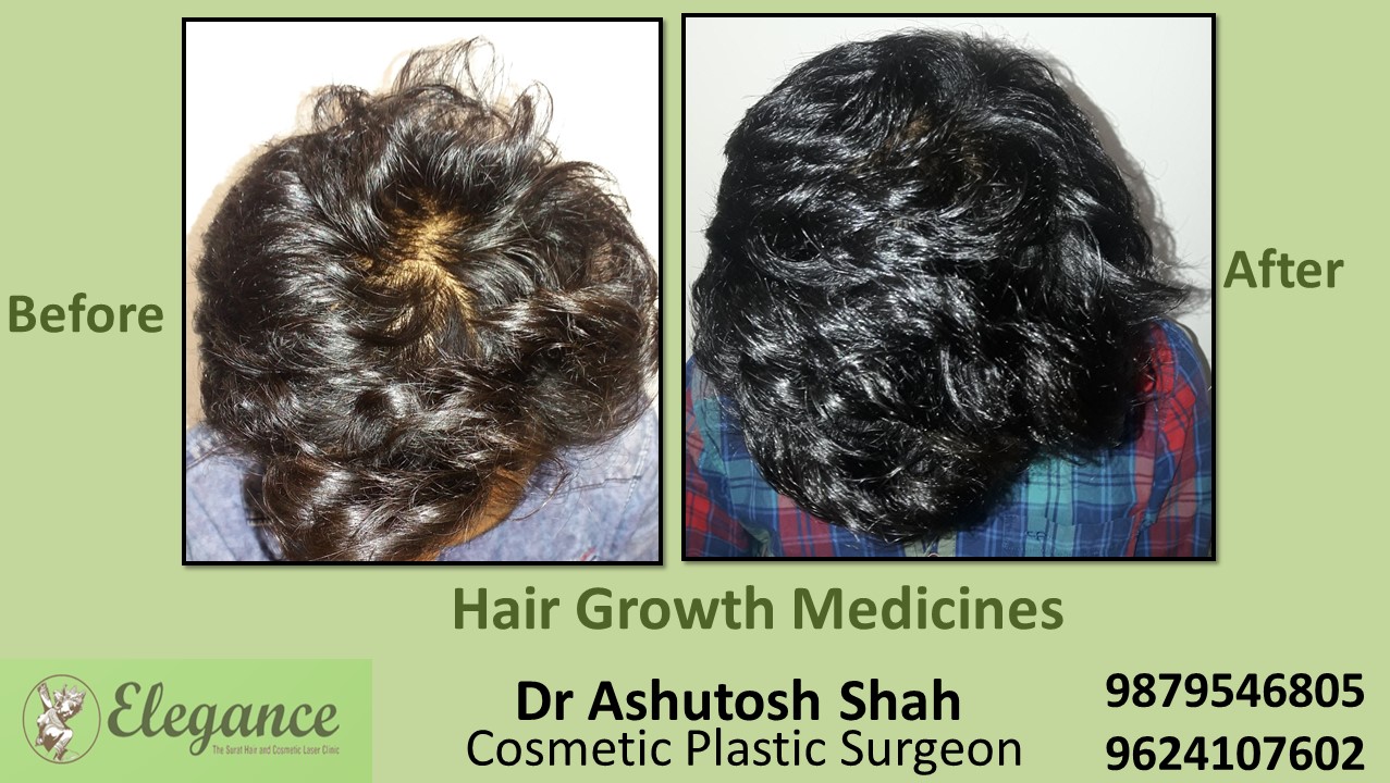 Hair Loss Treatment with Medicine in Navsari, Gujarat