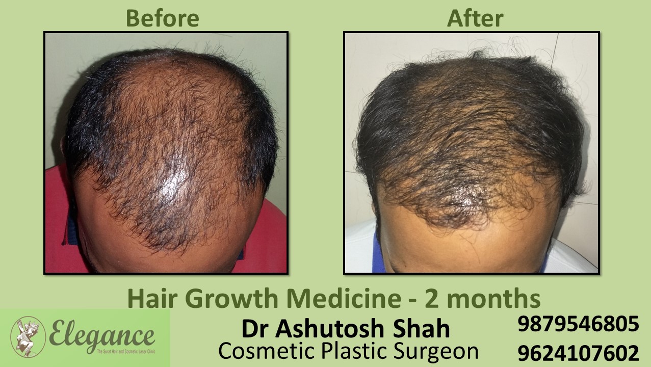 Hair Loss Treatment with Medicine in Pune