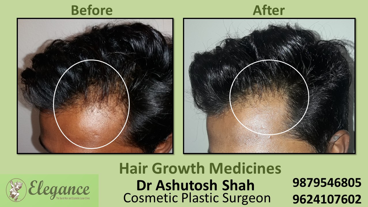 Hair Loss Treatment with Medicine in Surat, Gujarat