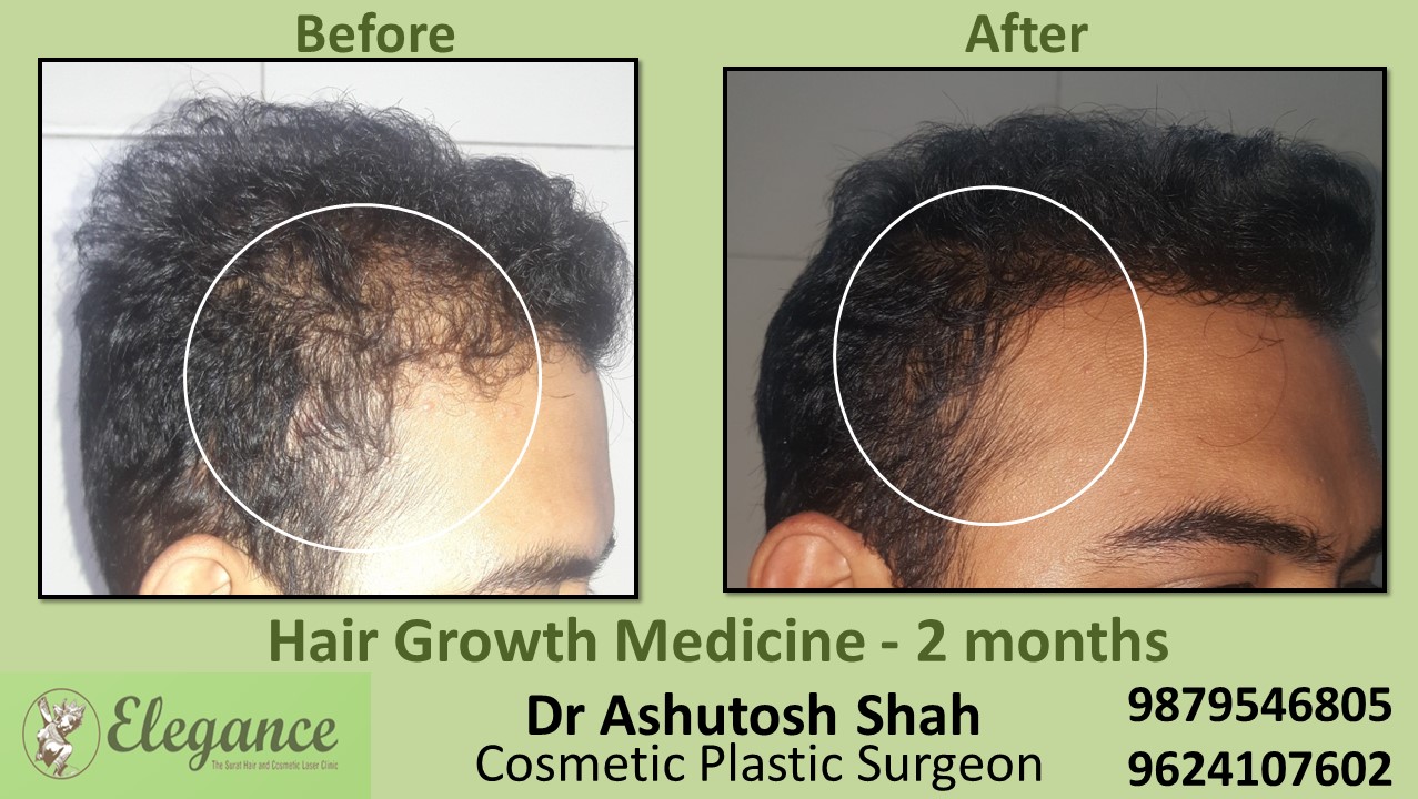Hair Loss Treatment with Medicine in Varachha Surat, Gujarat