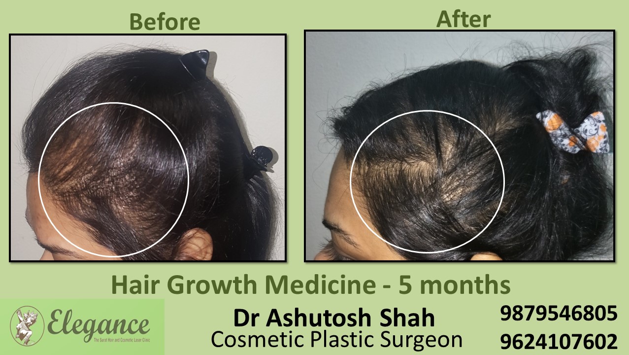 Hair Regrowth Treatment with Medication In Ankleshwar Gujarat