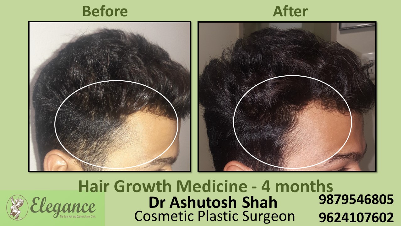 Hair Regrowth Treatment with Medication In Bardoli Gujarat