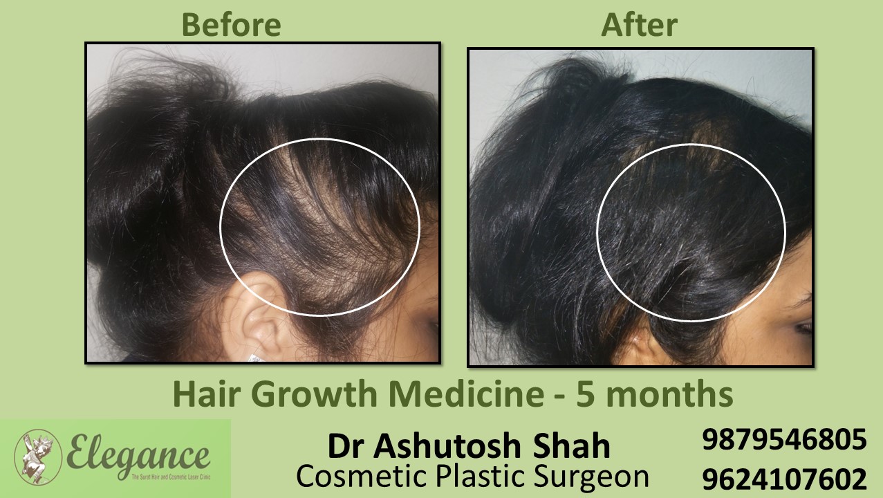 Hair Regrowth Treatment with Medication In Bharuch Gujarat