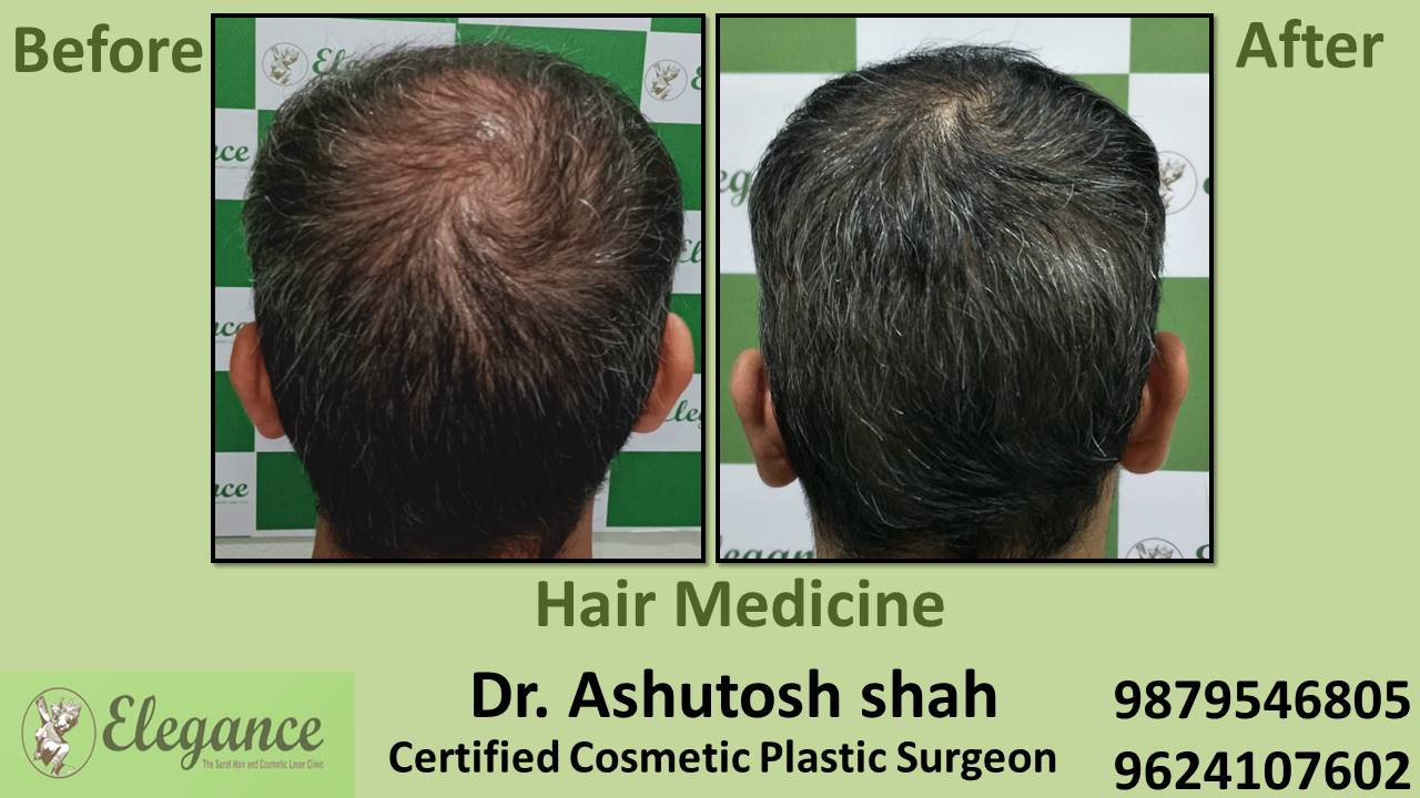 Hair Regrowth Treatment with Medication In kim Gujarat