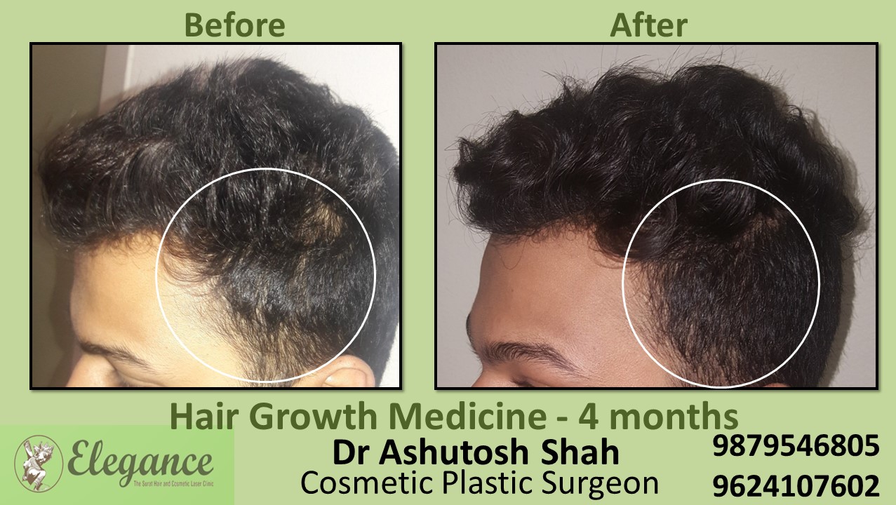 Hair Regrowth Treatment with Medication In kosamba Gujarat