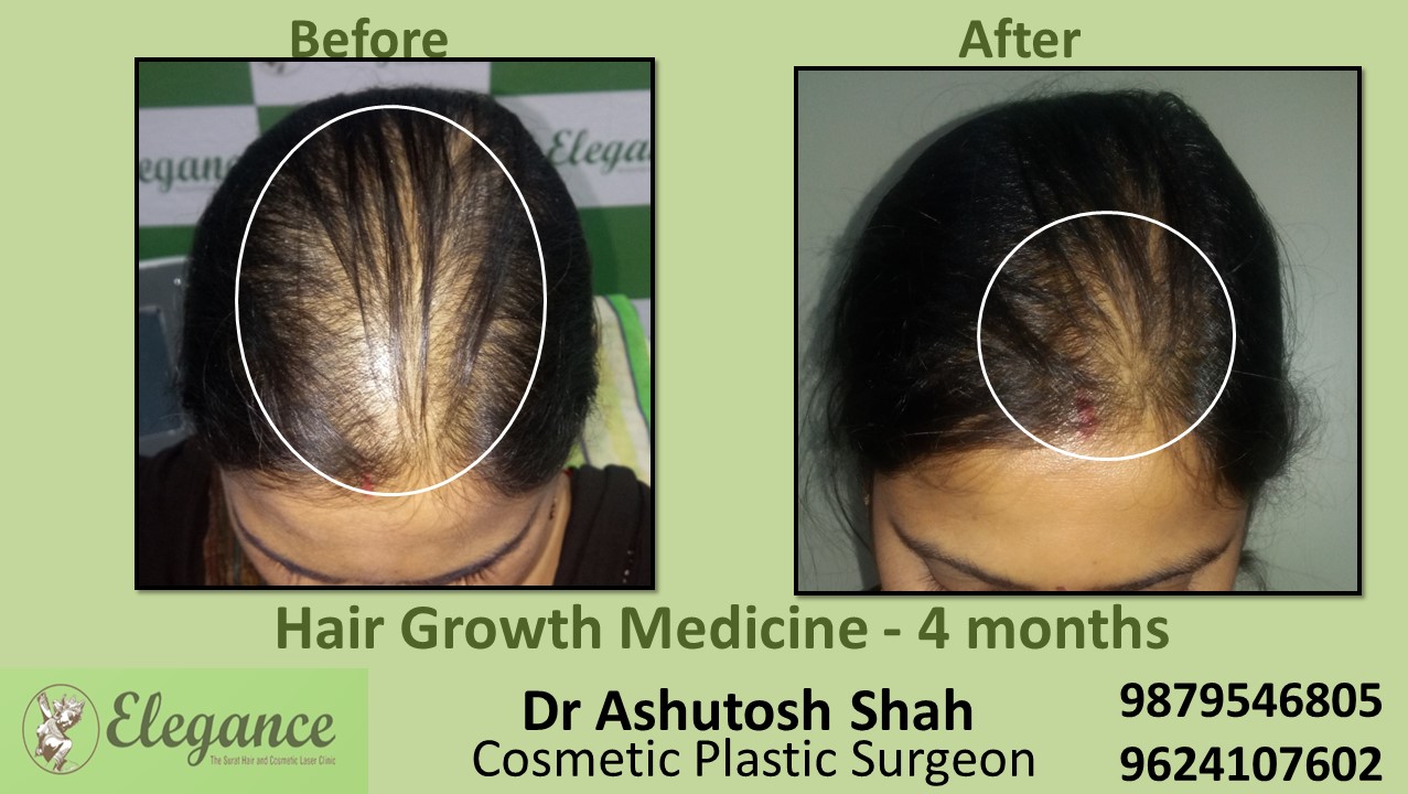 Hair Regrowth Treatment with Medication In Navsari Gujarat