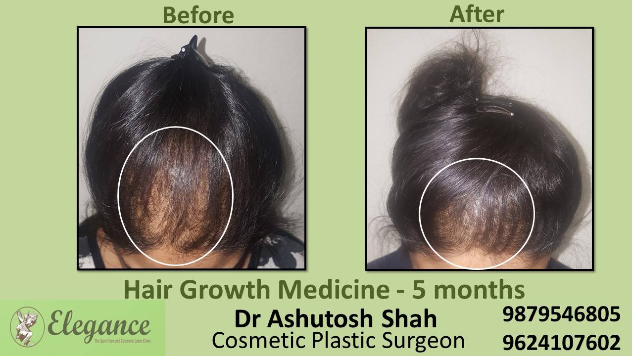 Hair Regrowth Treatment with Medication In Surat Gujarat