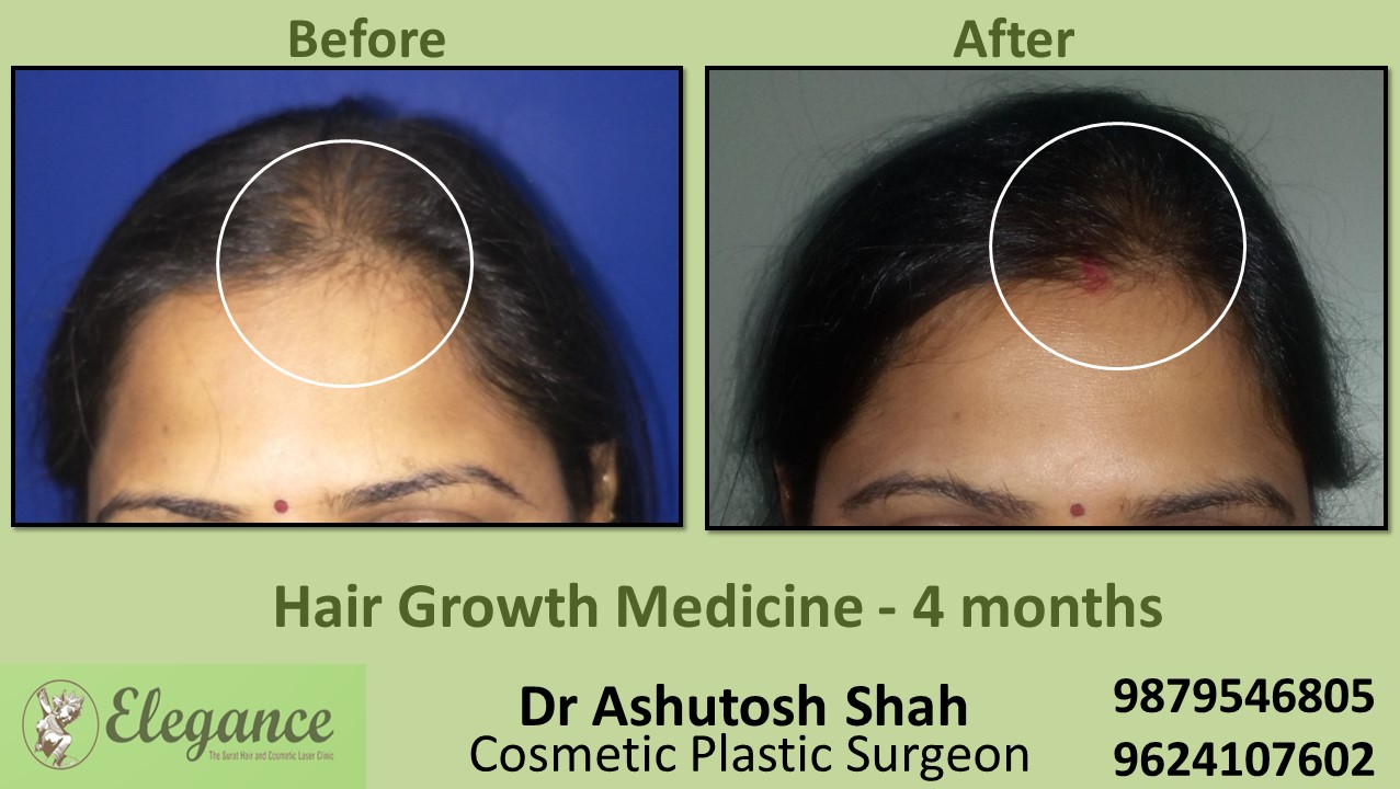 Hair Regrowth Treatment with Medication In Valsad Gujarat