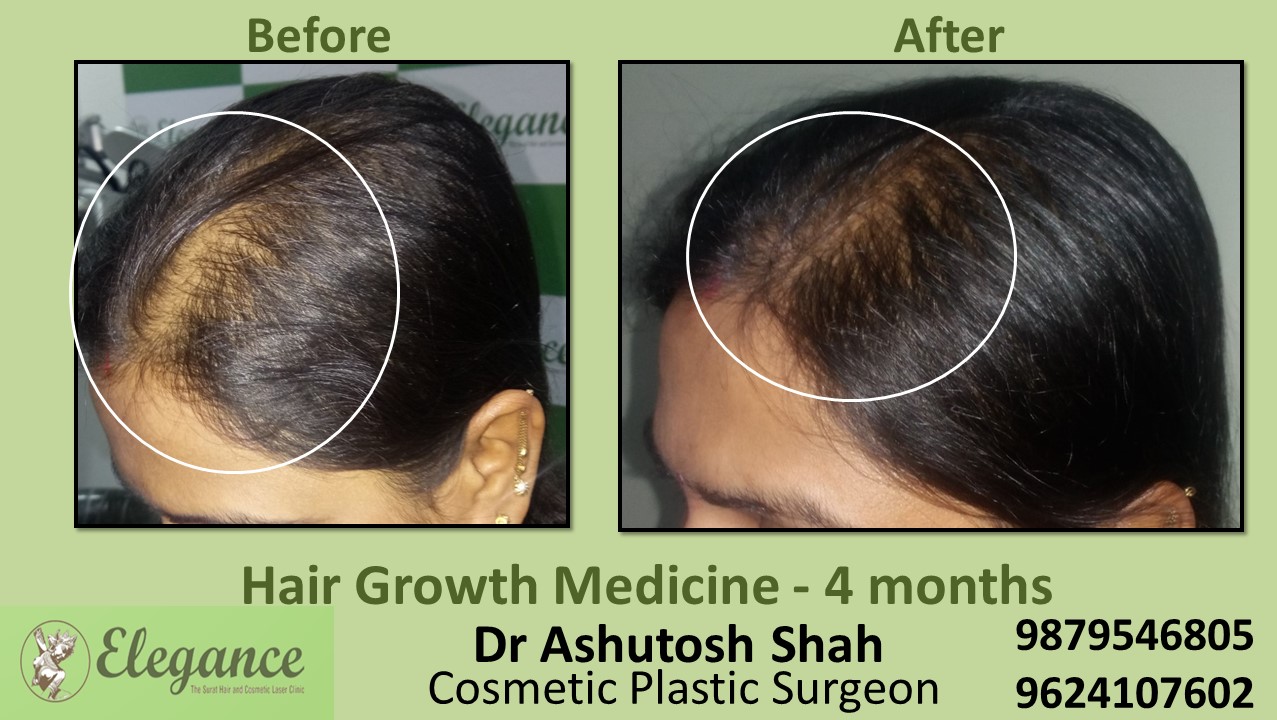 Hair Regrowth Treatment with Medication In Vapi Gujarat