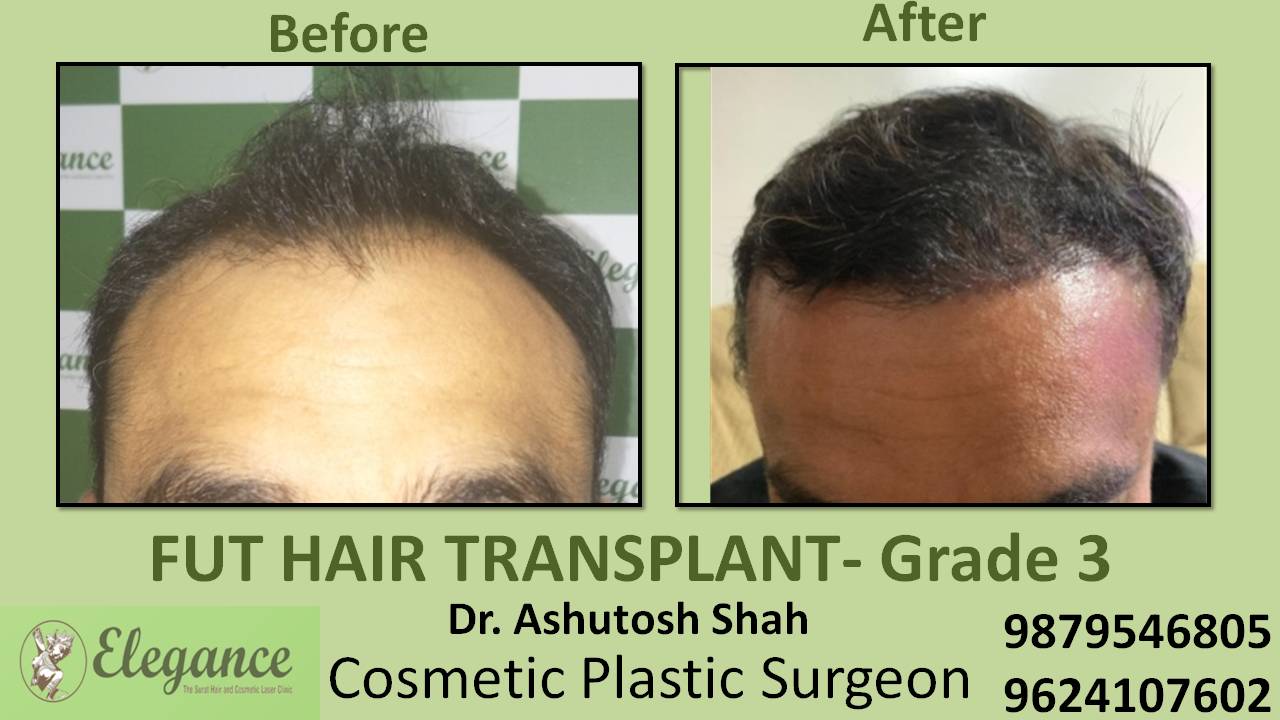 Grade 3 Hair transplant In Surat, Gujarat, India