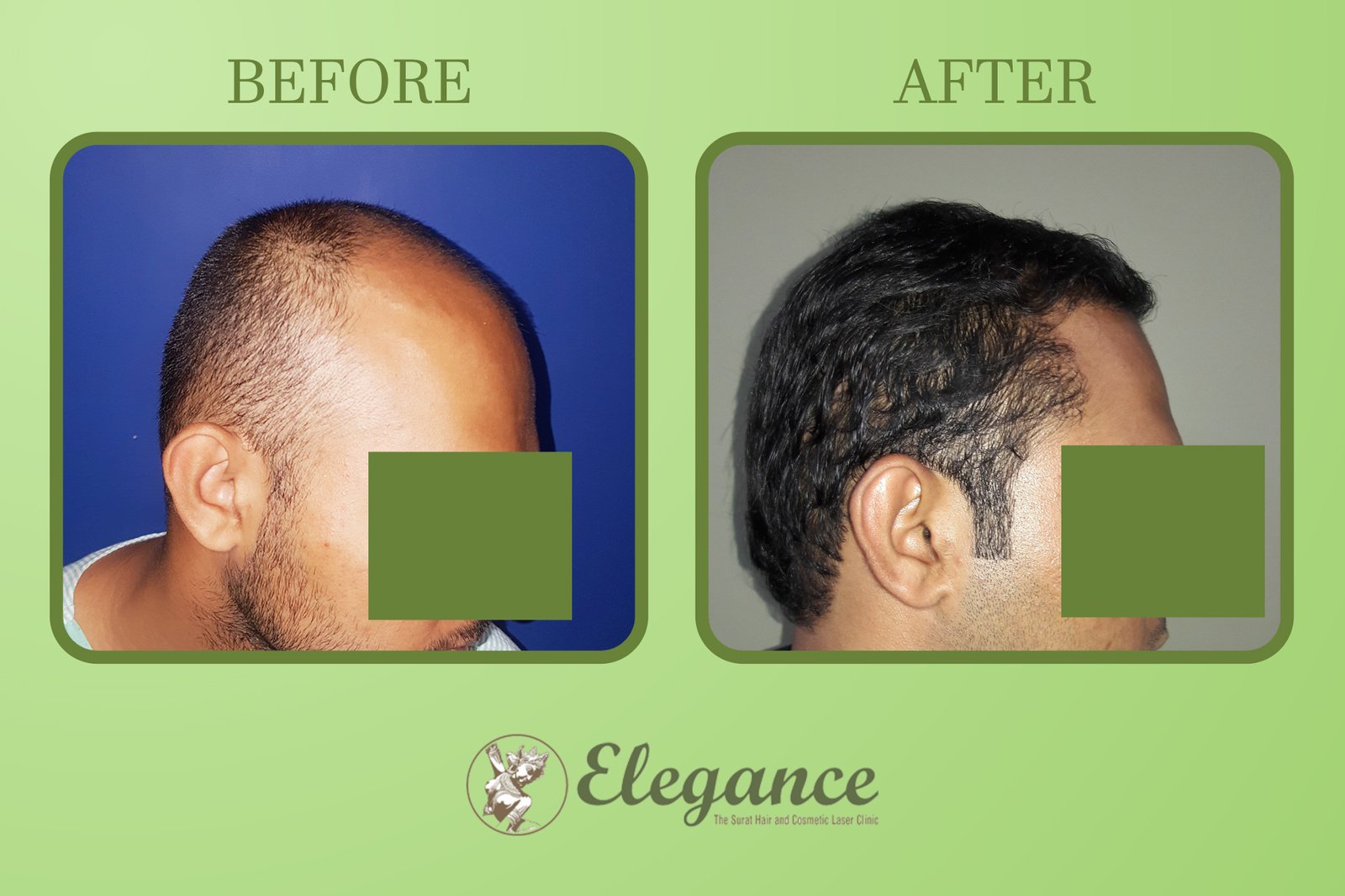 Male Hair Transplant in Bharuch, Gujarat, India